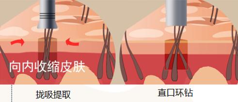 发缝处为什么容易脱发